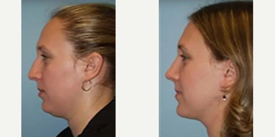 Dermal Fillers before and after photo