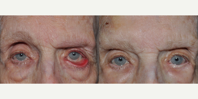 Eyelid Retraction Repair before and after photo