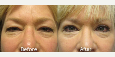 Eyelid Surgery before and after photo