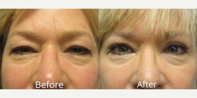 Eyelid Surgery before and after photo