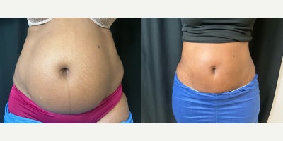 Tickle Lipo before and after photo