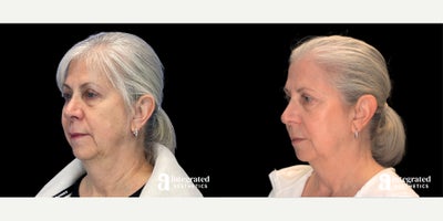 Botox before and after photo