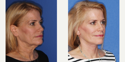 Facelift before and after photo