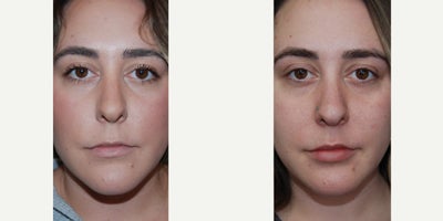 Lip Fillers before and after photo