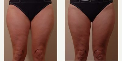 Liposculpture before and after photo