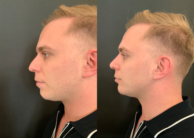 Dermal Fillers before and after photo