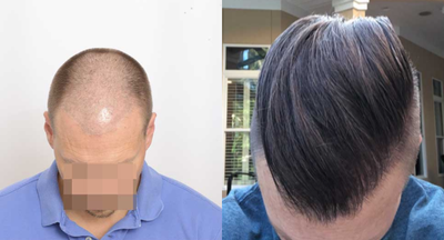 FUE Hair Transplant before and after photo