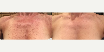 Laser Resurfacing before and after photo