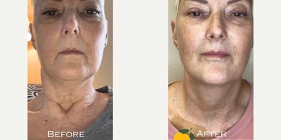 Radiesse before and after photo