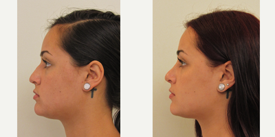 Rhinoplasty before and after photo