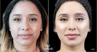 Botox before and after photo