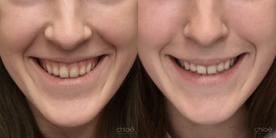 Botox for Gummy Smile before and after photo