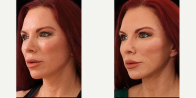 CO2 Laser before and after photo