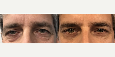 Eyelid Surgery before and after photo