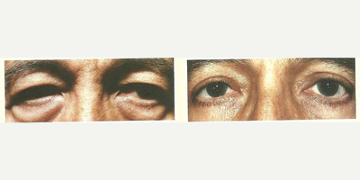 Eyelid Surgery before and after photo