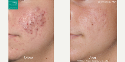 Fraxel Laser before and after photo