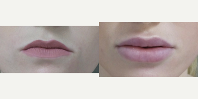 Lip Fillers before and after photo