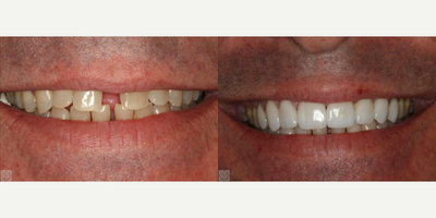 Porcelain Veneers before and after photo