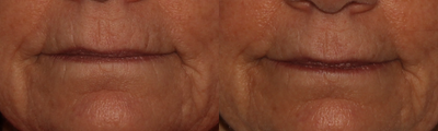 Dermal Fillers before and after photo