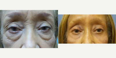 Eyelid Surgery before and after photo