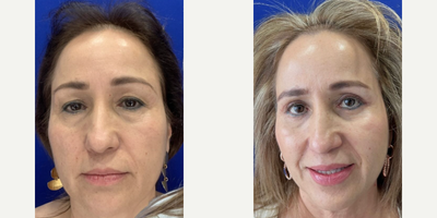 Eyelid Surgery before and after photo