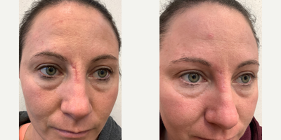 IPL before and after photo
