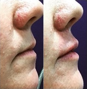 Juvederm before and after photo