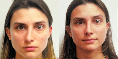 Revision Rhinoplasty before and after photo