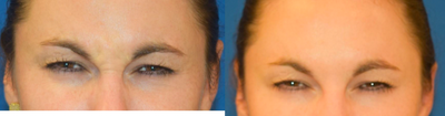 Botox before and after photo