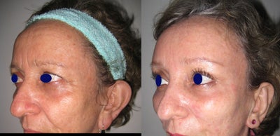 Brow Lift before and after photo