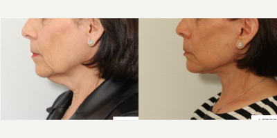Facelift before and after photo