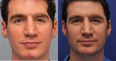 Facial Fat Transfer before and after photo