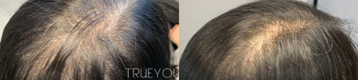 Hair Loss Treatment before and after photo