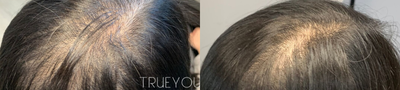 Hair Loss Treatment before and after photo