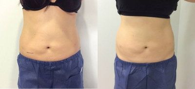 Vanquish before and after photo
