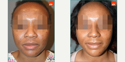 African American Rhinoplasty before and after photo