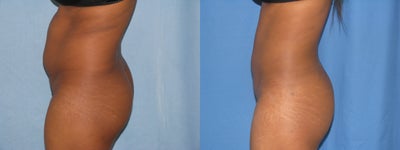 Liposuction before and after photo