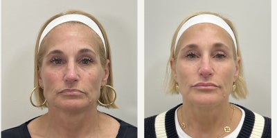 Nonsurgical Facelift before and after photo