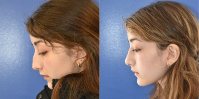 Rhinoplasty before and after photo