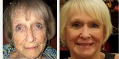 Facial Fat Transfer before and after photo