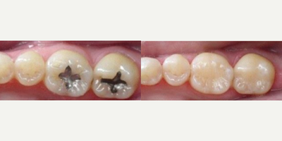 Tooth Repair before and after photo