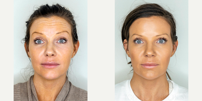 Botox before and after photo