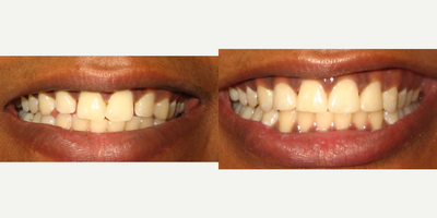 Dental Bonding before and after photo