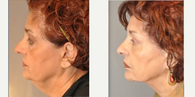 Neck Lift before and after photo