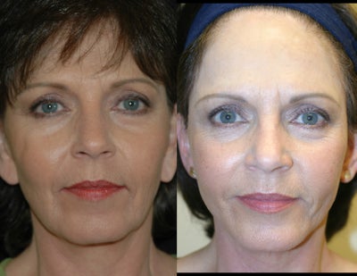 Facelift before and after photo