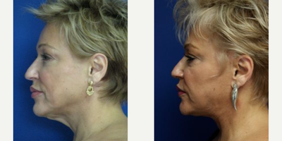 Facelift before and after photo