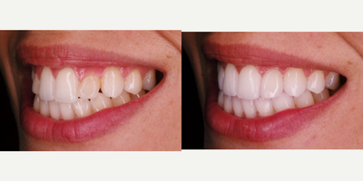Gum Lift before and after photo