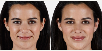 Juvederm before and after photo