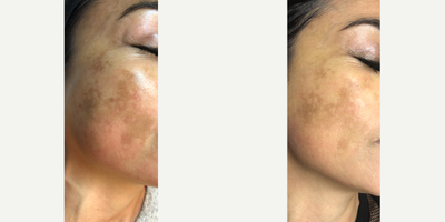Laser Genesis before and after photo