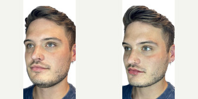 Chin Filler before and after photo